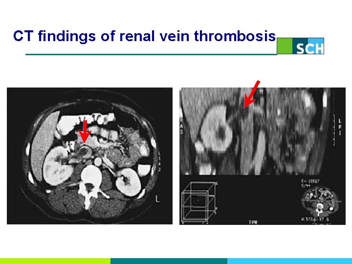 CT findings of renal vein thrombosis 