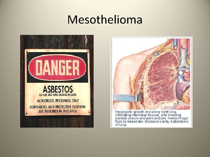 Mesothelioma 