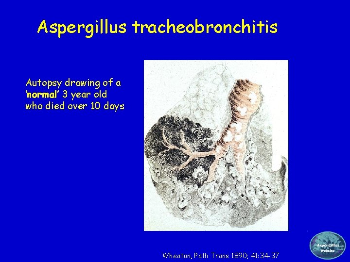 The extraordinary spectrum of diseases caused by Aspergillus