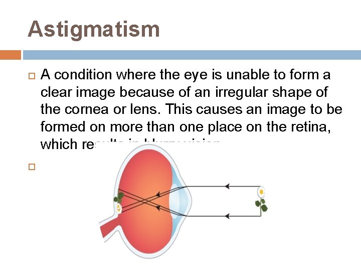 Astigmatism A condition where the eye is unable to form a clear image because