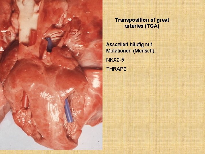 Transposition of great arteries (TGA) Assoziiert häufig mit Mutationen (Mensch): NKX 2 -5 THRAP