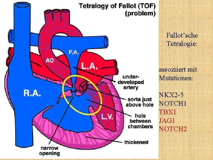 Fallot’sche Tetralogie: assoziiert mit Mutationen: NKX 2 -5 NOTCH 1 TBX 1 JAG 1