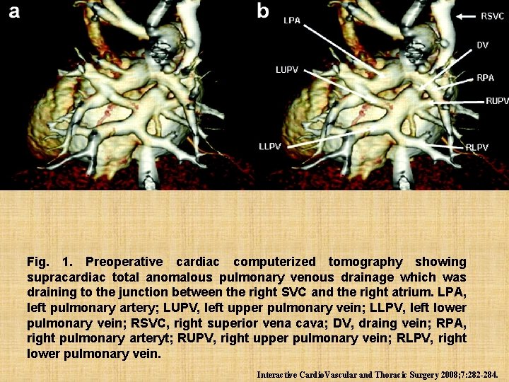 Fig. 1. Preoperative cardiac computerized tomography showing supracardiac total anomalous pulmonary venous drainage which