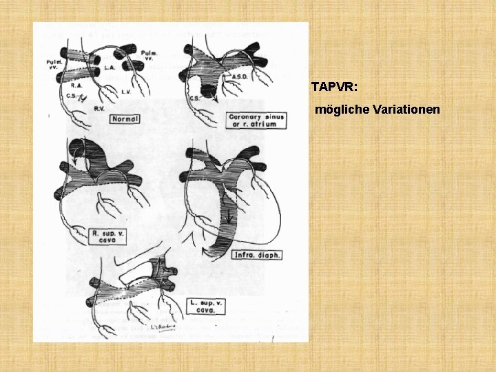 TAPVR: mögliche Variationen 