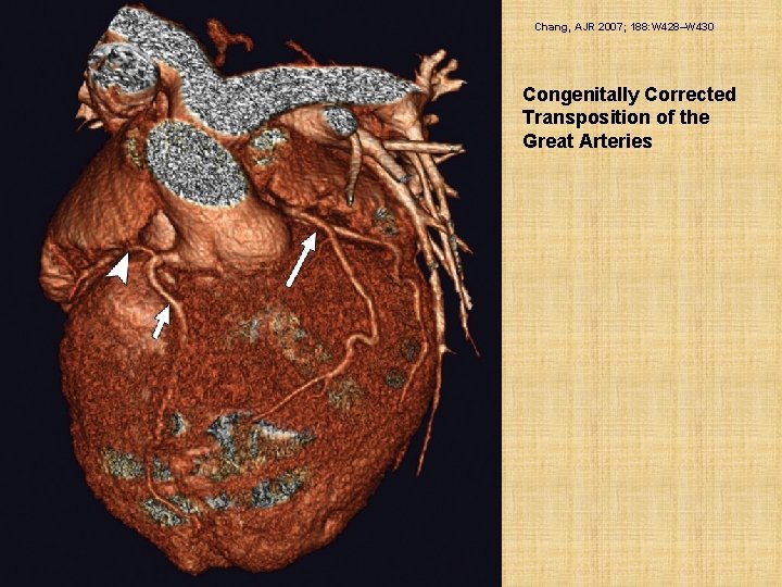 Chang, AJR 2007; 188: W 428–W 430 Congenitally Corrected Transposition of the Great Arteries