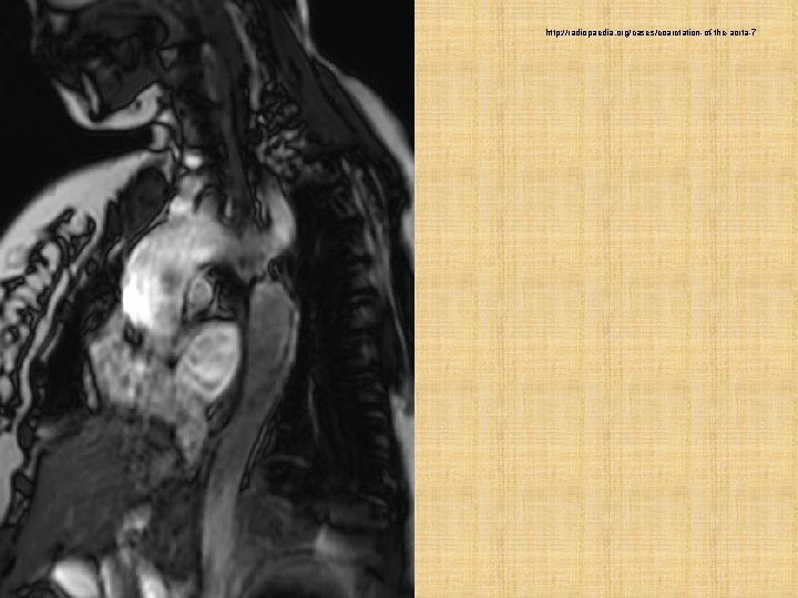 http: //radiopaedia. org/cases/coarctation-of-the-aorta-7 