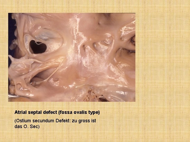 Atrial septal defect (fossa ovalis type) (Ostium secundum Defekt: zu gross ist das O.