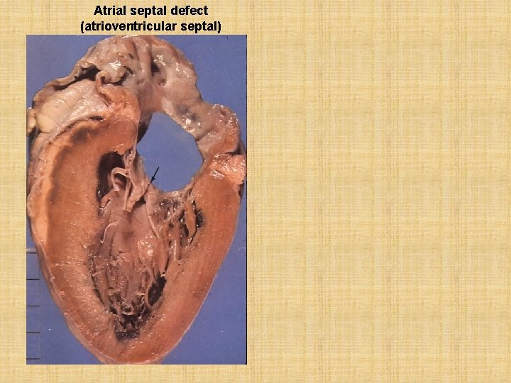 Atrial septal defect (atrioventricular septal) 