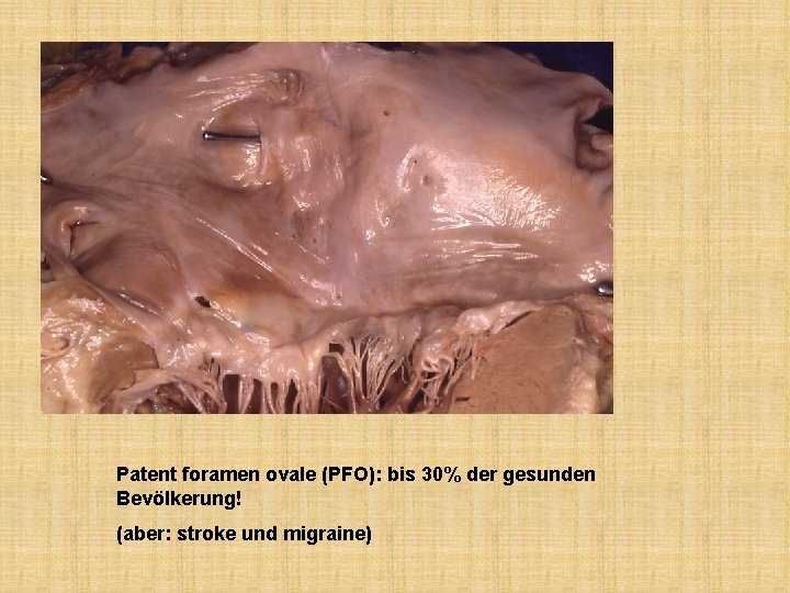 Patent foramen ovale (PFO): bis 30% der gesunden Bevölkerung! (aber: stroke und migraine) 