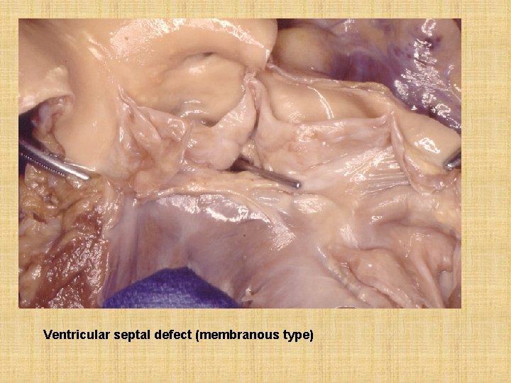 Ventricular septal defect (membranous type) 