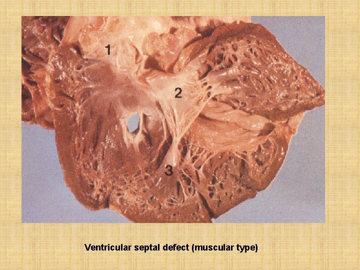 Ventricular septal defect (muscular type) 