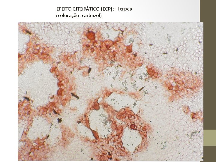 EFEITO CITOPÁTICO (ECP): Herpes (coloração: carbazol) 