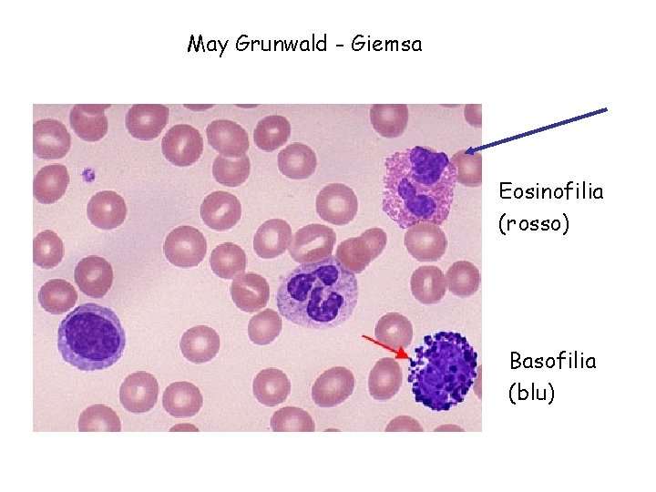 May Grunwald - Giemsa Eosinofilia (rosso) Basofilia (blu) 