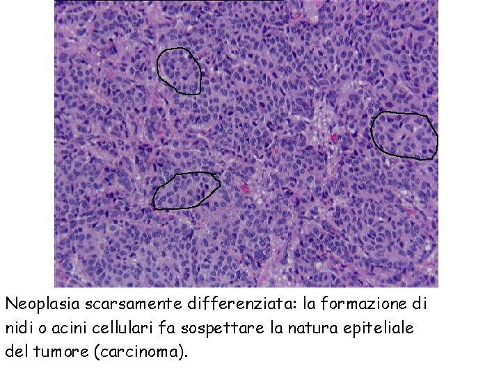 Neoplasia scarsamente differenziata: la formazione di nidi o acini cellulari fa sospettare la natura