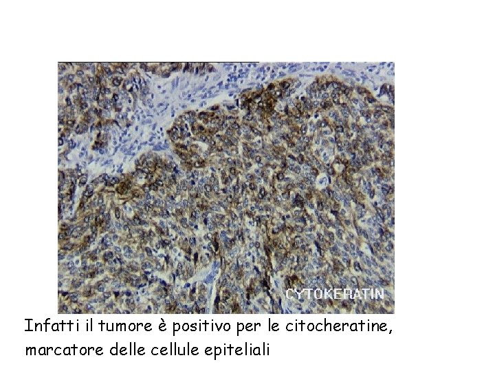 Infatti il tumore è positivo per le citocheratine, marcatore delle cellule epiteliali 