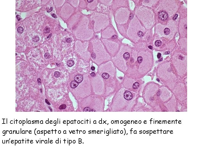 Il citoplasma degli epatociti a dx, omogeneo e finemente granulare (aspetto a vetro smerigliato),