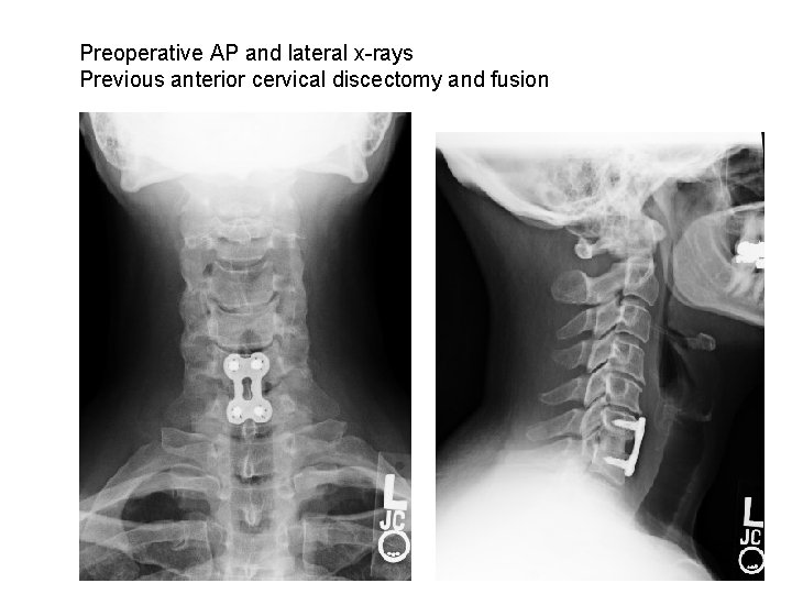 Preoperative AP and lateral x-rays Previous anterior cervical discectomy and fusion 