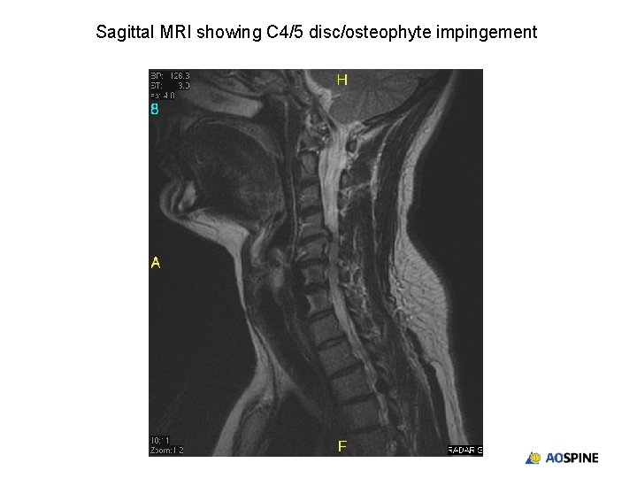 Sagittal MRI showing C 4/5 disc/osteophyte impingement 