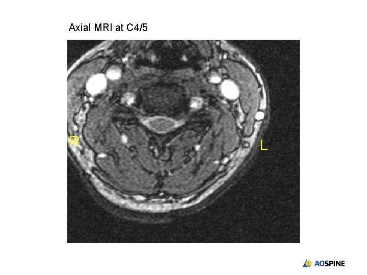 Axial MRI at C 4/5 L 