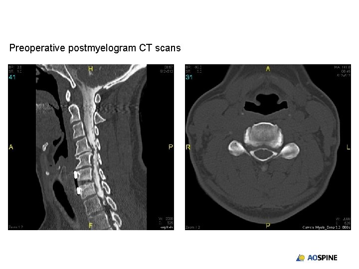 Preoperative postmyelogram CT scans 