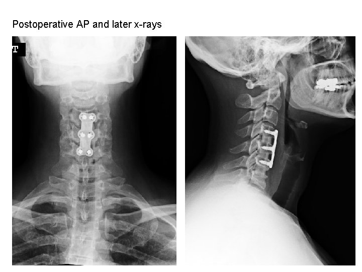 Postoperative AP and later x-rays 