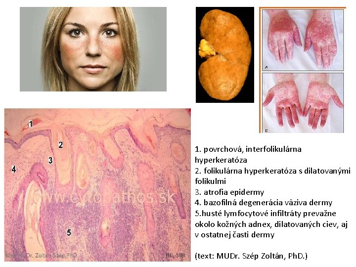 1. povrchová, interfolikulárna hyperkeratóza 2. folikulárna hyperkeratóza s dilatovanými folikulmi 3. atrofia epidermy 4.