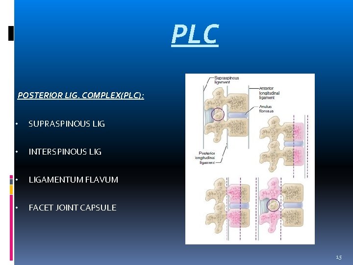 PLC POSTERIOR LIG. COMPLEX(PLC): • SUPRASPINOUS LIG • INTERSPINOUS LIG • LIGAMENTUM FLAVUM •