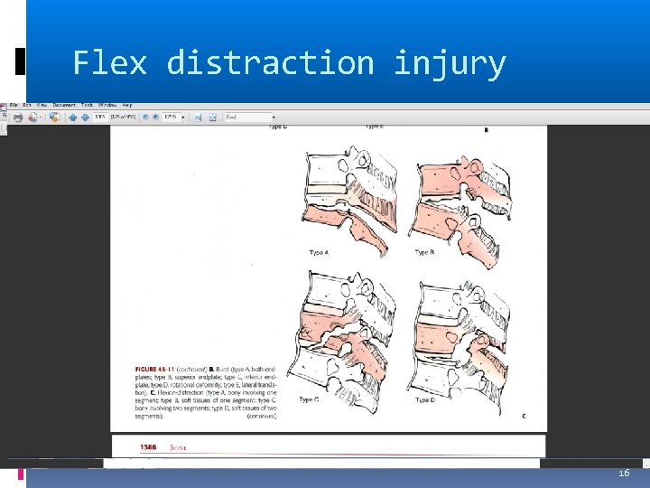 Flex distraction injury 16 