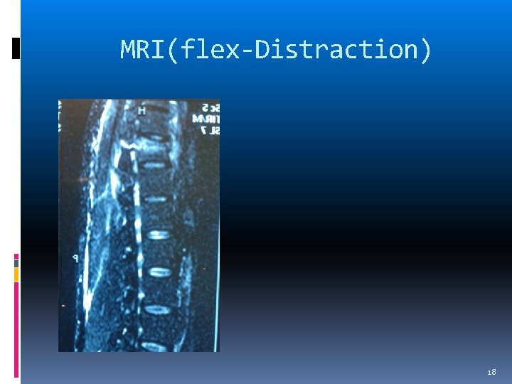 MRI(flex-Distraction) 18 