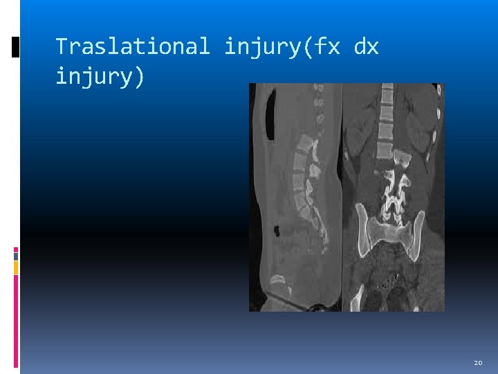 Traslational injury(fx dx injury) 20 