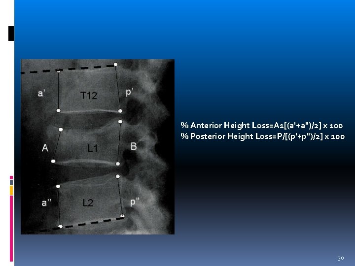 % Anterior Height Loss=A 1[(a'+a")/2] x 100 % Posterior Height Loss=P/[(p'+p")/2] x 100 30