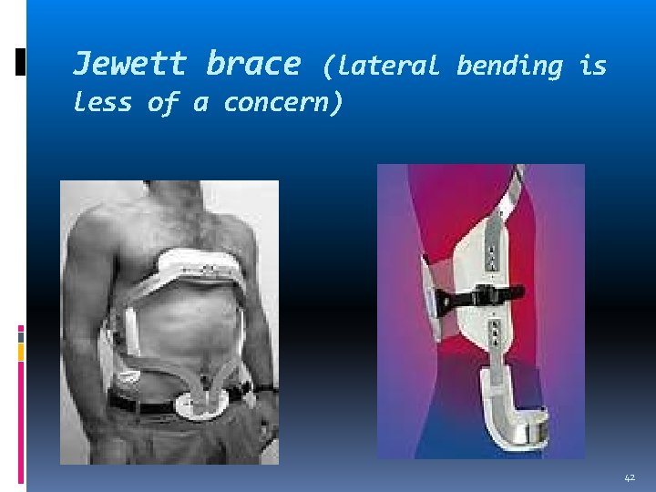 Jewett brace (lateral bending is less of a concern) 42 