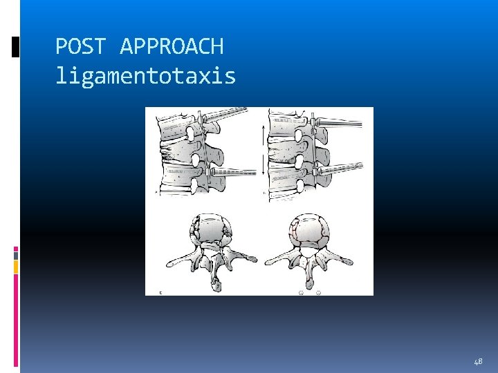 POST APPROACH ligamentotaxis 48 