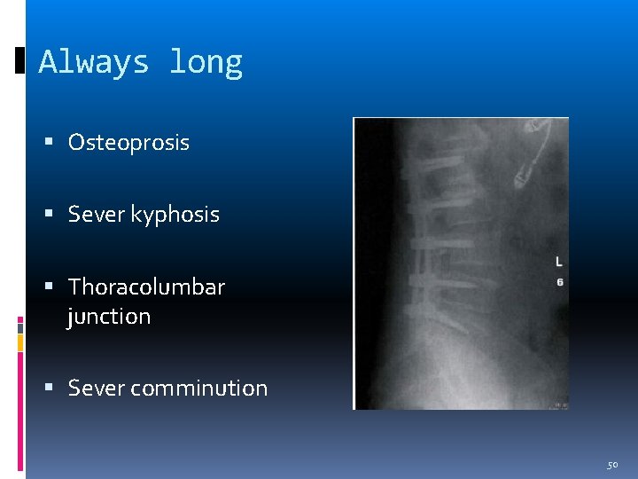 Always long Osteoprosis Sever kyphosis Thoracolumbar junction Sever comminution 50 