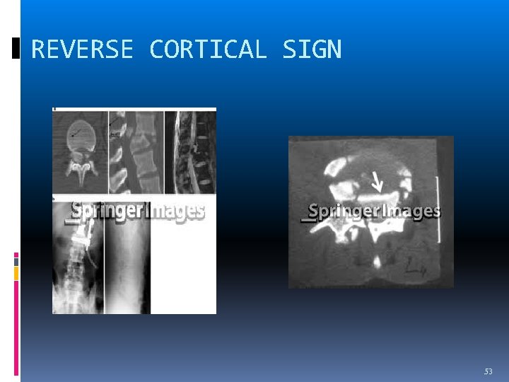 REVERSE CORTICAL SIGN 53 