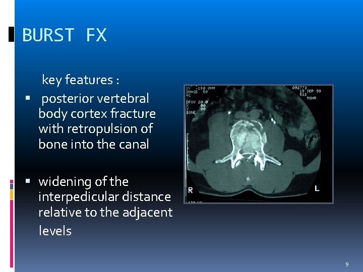 BURST FX key features : posterior vertebral body cortex fracture with retropulsion of bone