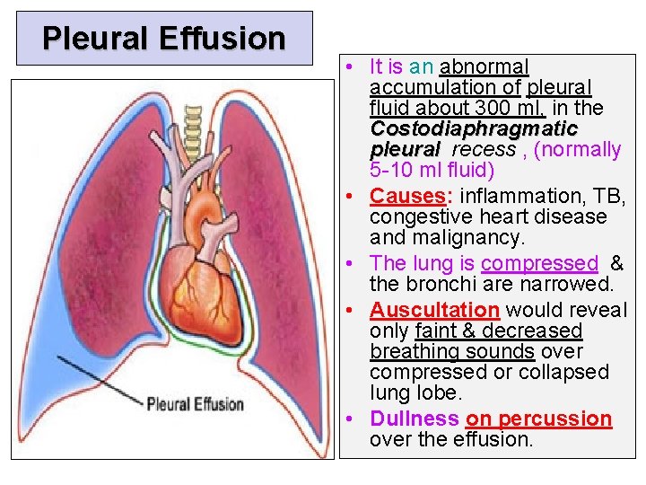 Pleural Effusion • It is an abnormal accumulation of pleural fluid about 300 ml,