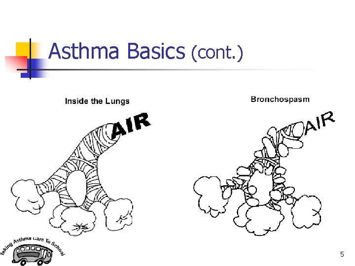 Asthma Basics (cont. ) 5 