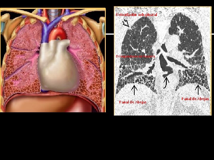 Reticulación sub-pleural Bronquiectasia de tracción Panal de Abejas 