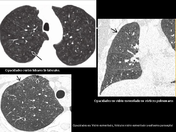 Opacidades centro lobares bi-laterales. Opacidades en vidrio esmerilado en vértices pulmonares Opacidades en Vidrio