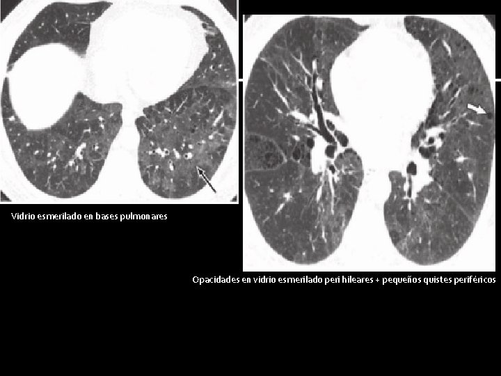 Vidrio esmerilado en bases pulmonares Opacidades en vidrio esmerilado peri hileares + pequeños quistes