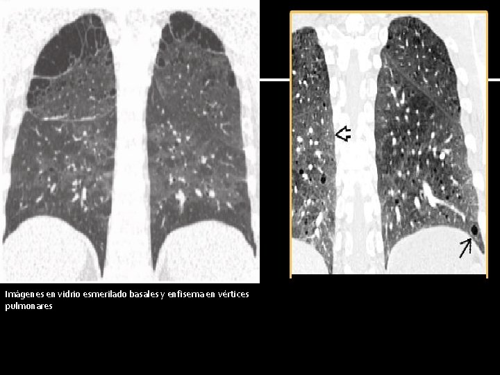 Imágenes en vidrio esmerilado basales y enfisema en vértices pulmonares 