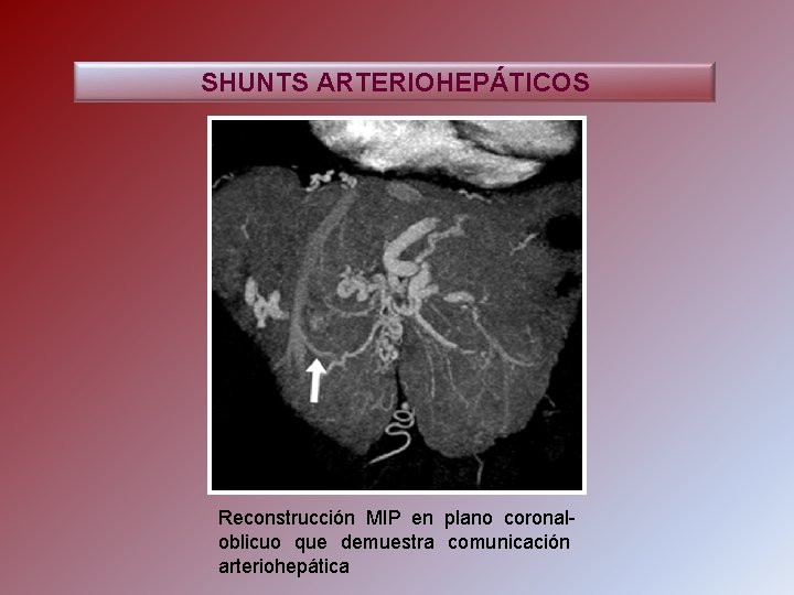 SHUNTS ARTERIOHEPÁTICOS Reconstrucción MIP en plano coronaloblicuo que demuestra comunicación arteriohepática 