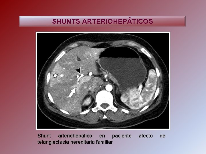 SHUNTS ARTERIOHEPÁTICOS Shunt arteriohepático en paciente telangiectasia hereditaria familiar afecto de 