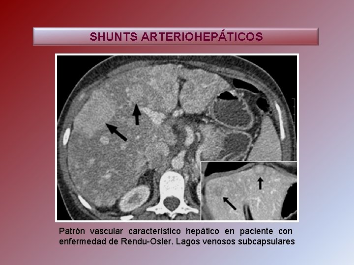 SHUNTS ARTERIOHEPÁTICOS Patrón vascular característico hepático en paciente con enfermedad de Rendu-Osler. Lagos venosos