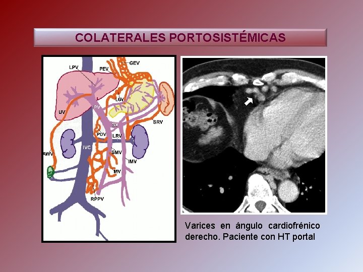 COLATERALES PORTOSISTÉMICAS Varices en ángulo cardiofrénico derecho. Paciente con HT portal 