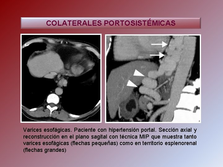 COLATERALES PORTOSISTÉMICAS Varices esofágicas. Paciente con hipertensión portal. Sección axial y reconstrucción en el