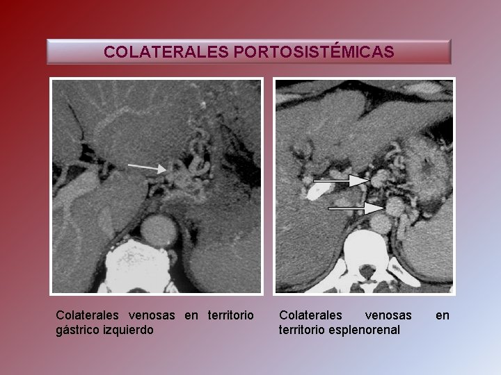 COLATERALES PORTOSISTÉMICAS Colaterales venosas en territorio gástrico izquierdo Colaterales venosas territorio esplenorenal en 