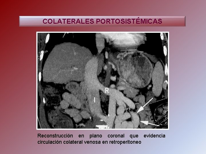 COLATERALES PORTOSISTÉMICAS Reconstrucción en plano coronal que evidencia circulación colateral venosa en retroperitoneo 