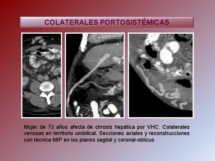 COLATERALES PORTOSISTÉMICAS Mujer de 73 años afecta de cirrosis hepática por VHC. Colaterales venosas